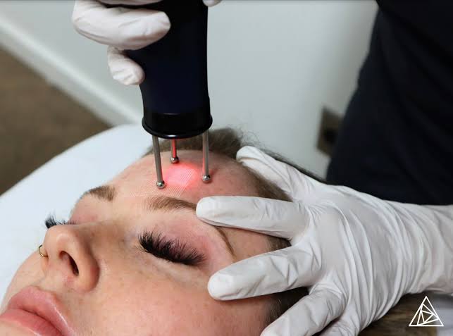 Dermablate Er:YAG laser resurfacing treatment being performed on patient’s face at Yeppeun Skin Clinic, Jumeirah 2, Dubai