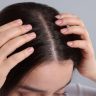 Scalp MTS microneedling treatment for hair thinning at Yeppeun Skin Clinic Jumeirah 2 Dubai