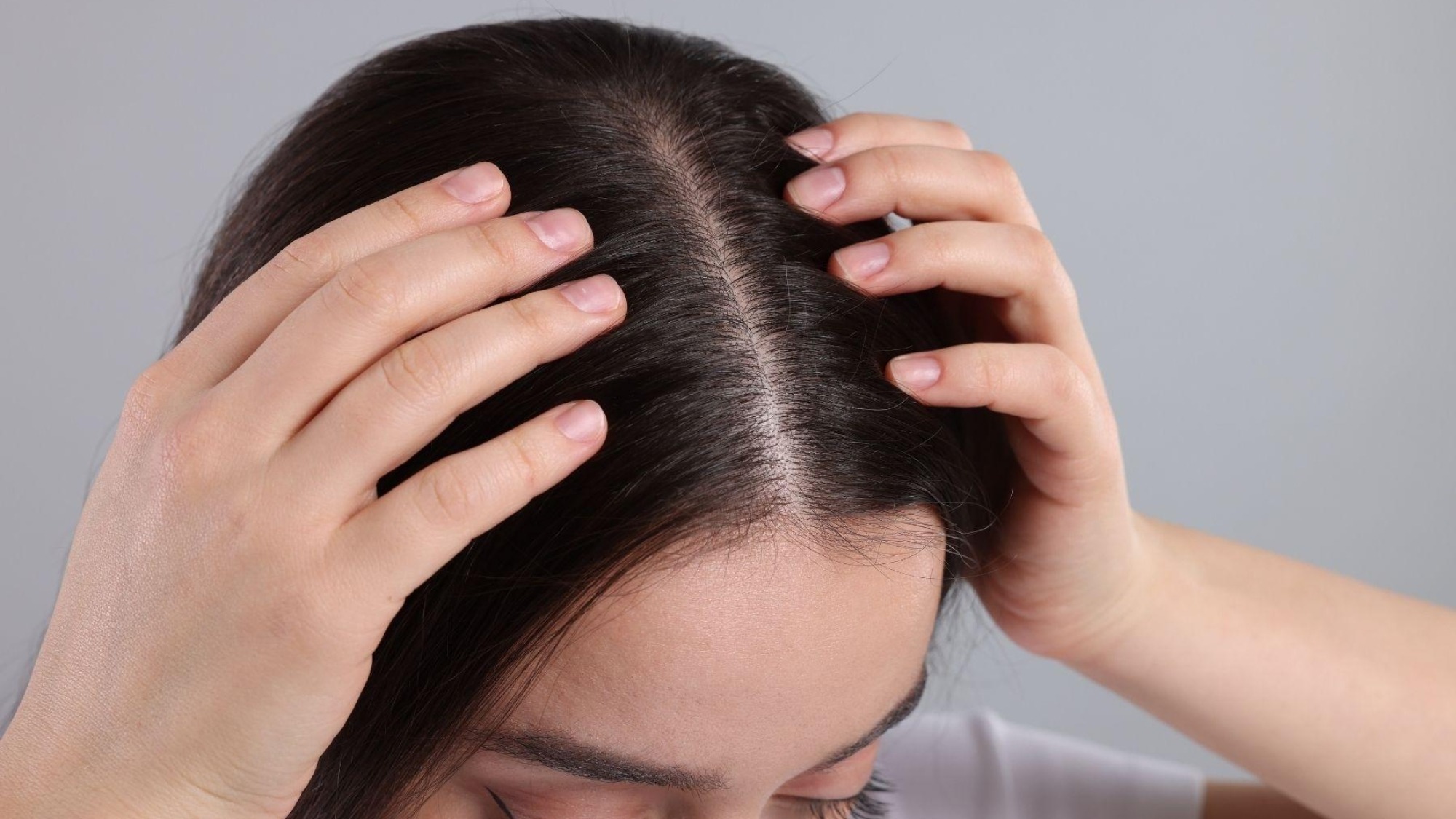 Scalp MTS microneedling treatment for hair thinning at Yeppeun Skin Clinic Jumeirah 2 Dubai