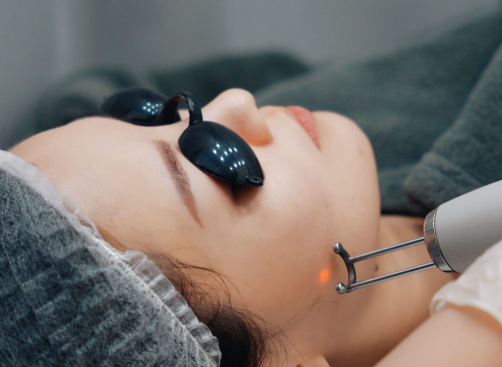 Pico Tone-Up Laser treatment for melasma, pigmentation, and tattoo removal at Yeppeun Skin Clinic, Jumeirah 2, Dubai