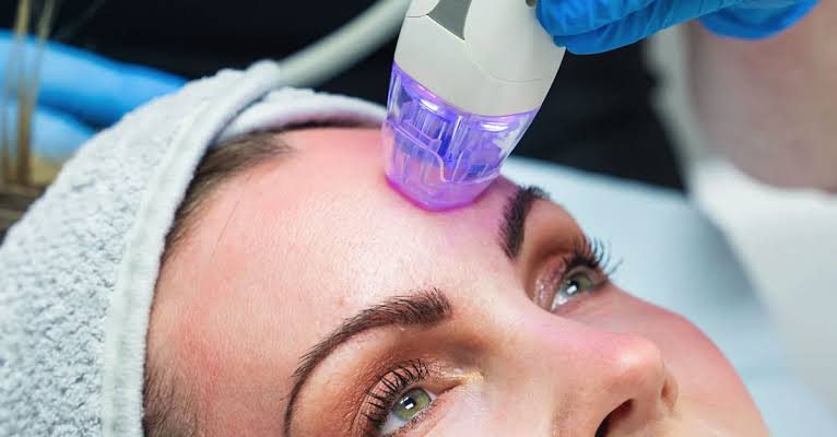 RF microneedling acne extraction treatment session at Yeppeun Skin Clinic, DHA-licensed Korean-standard clinic in Jumeirah 2, Dubai